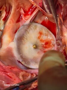 Born with a Rare Heart Defect, Kolkata Woman Gets a New Lease of Life at BM Birla Heart Hospital