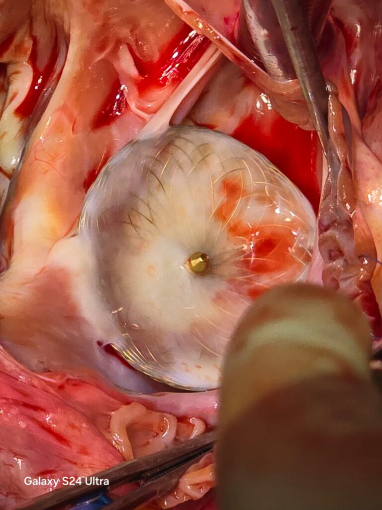 Rare Congenital Heart Defect Successfully Treated with Advanced Surgery at BM Birla Heart Hospital